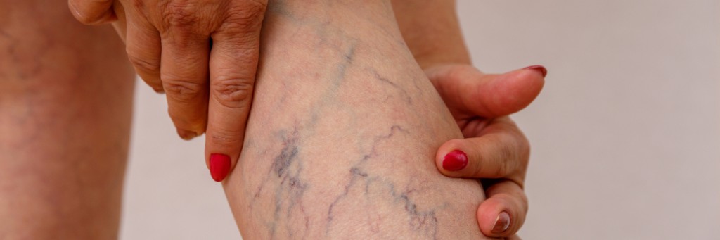Hands touching leg with varicose veins.